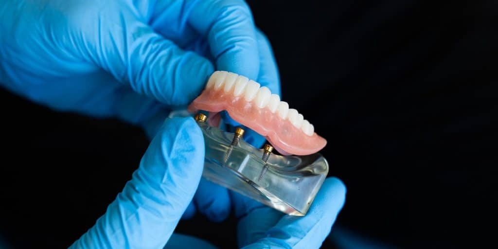 Plastic teeth model of implant supported dentures.
