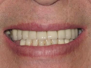 Smile gallery. Restored worn down teeth using full mouth crown and bridgework.