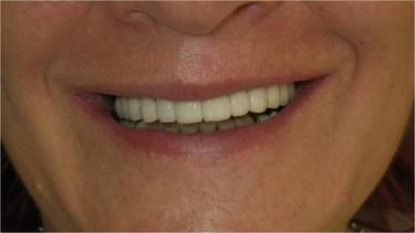 Smile gallery. Restored smile using implantation and permanent crowns.