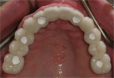 Smile gallery. View from under a patient's upper teeth showing implant placement.