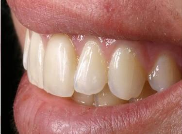 Smile gallery. Restored broken tooth with an implant and all ceramic crown.