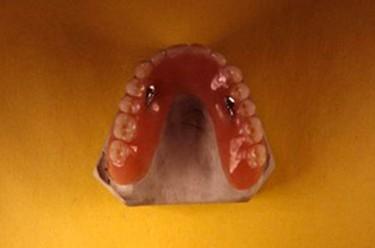 Smile gallery. Image of bar overdenture.