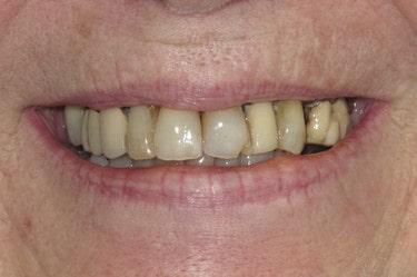 Smile gallery. Image of severely deteriorated teeth. Yellow teeth.