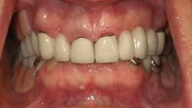 Smile gallery. Image of teeth with severely compromised roots and old deteriorated crowns.