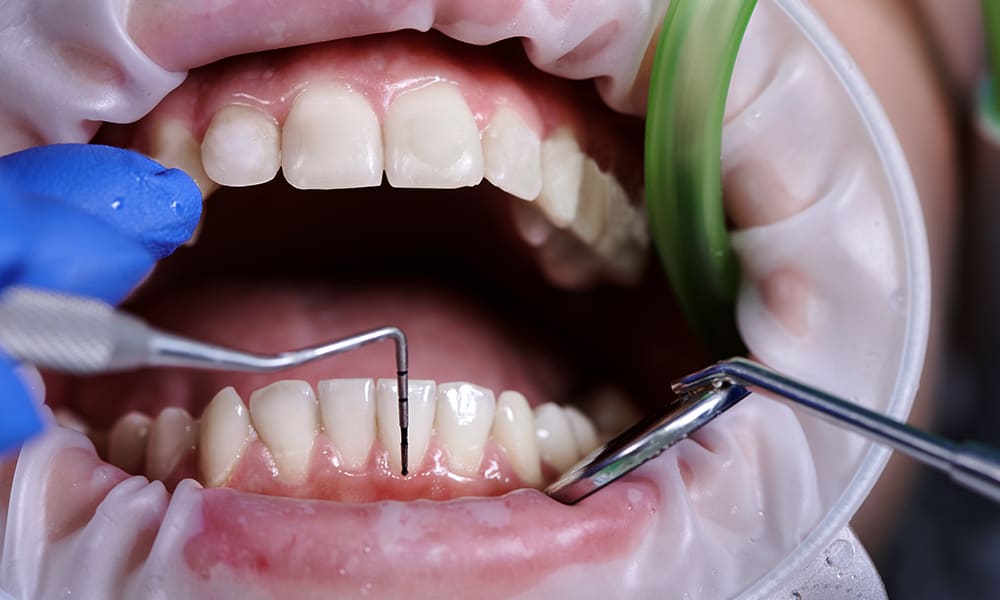 Patient's mouth set for crown lengthening. Disposable rubber dam, mouth mirror, and dental spoon.