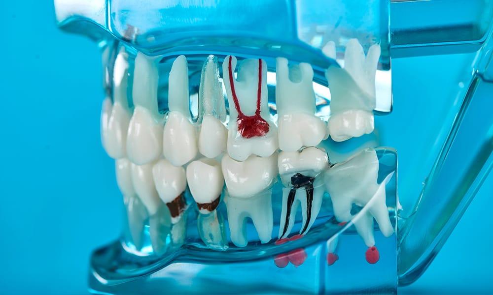 Clear teeth model showing diseases due for root amputation.