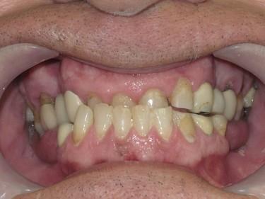 Smile gallery. Image of unattended worn down teeth resulting to severe bite loss.